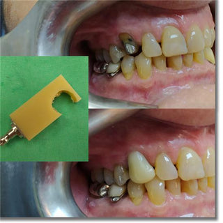 Bloco Monocromático de PMMA Sistema AG 71mm (13mm-20mm)