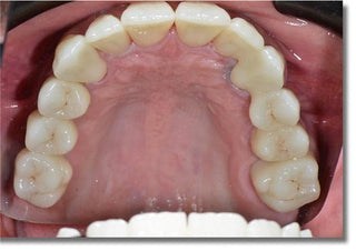 ST+Color Precolored Zirconia Block AG System  71mm